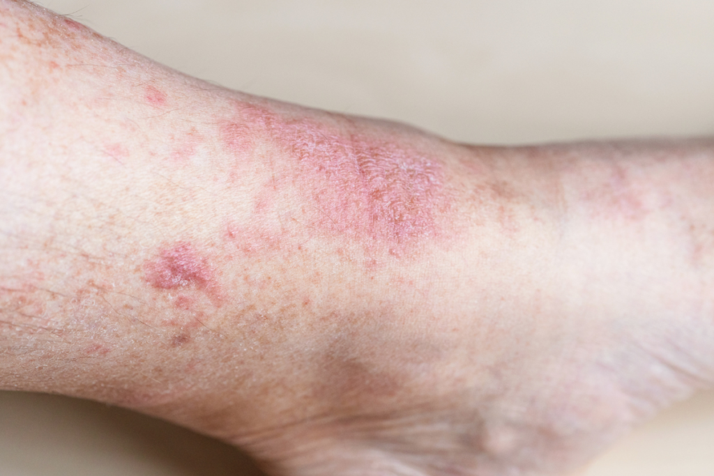 Red and irritated skin on the lower leg representing an eczema flare-up