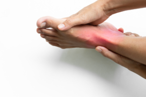 Person holding a painful red and inflamed foot during a possible gout attack.